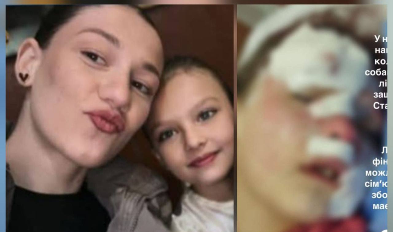 У Смілі дитину покусав собака, їй провели операцію на обличчі